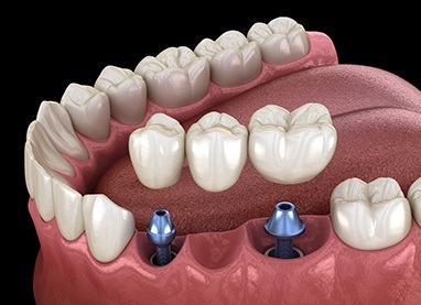 Animated dental implant supported fixed bridge